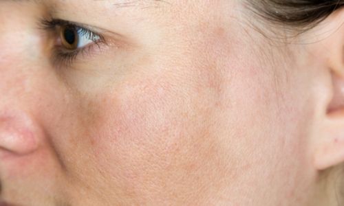4 Pregnancy Skin Problems Plus How To Treat Them chloasma
